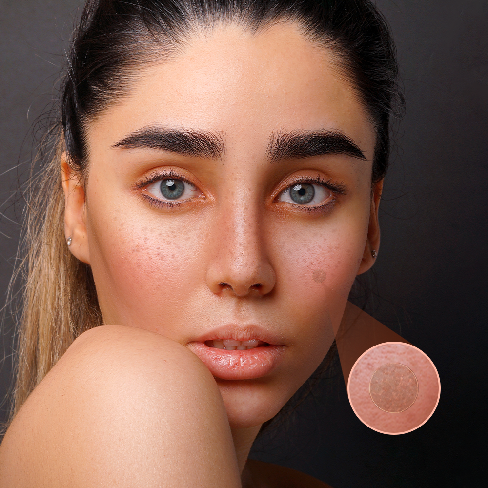 Acne Patches | Naked Cosmetics.
